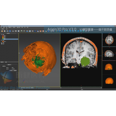 基于Arigin3D Pro V3.0的腦干膠質(zhì)瘤3D模型重建